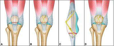 Ring-Pins combined with cable cerclage for the fixation of displaced inferior patellar pole fractures